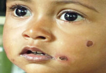 సిగిరెట్టు కోసం .. చిన్న పిల్లాడికి వాతలు పెట్టాడు , ప్రాణాపాయం !